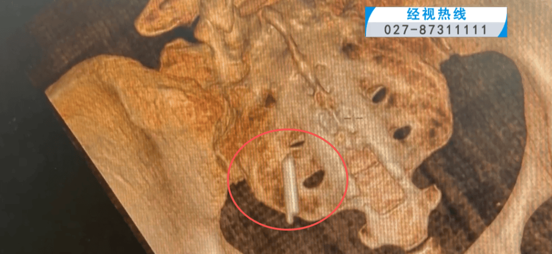 体温表在体内断裂,女子时隔22年彻底取出!医生:庆幸水银不在里面